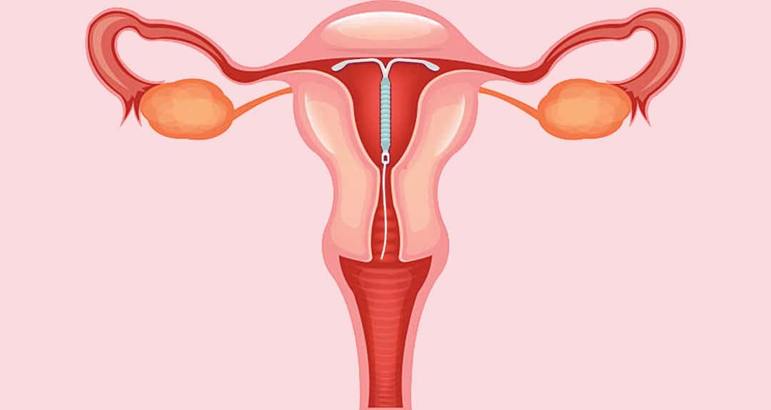 Everything you need to know about intrauterine contraceptive devices (IUD)