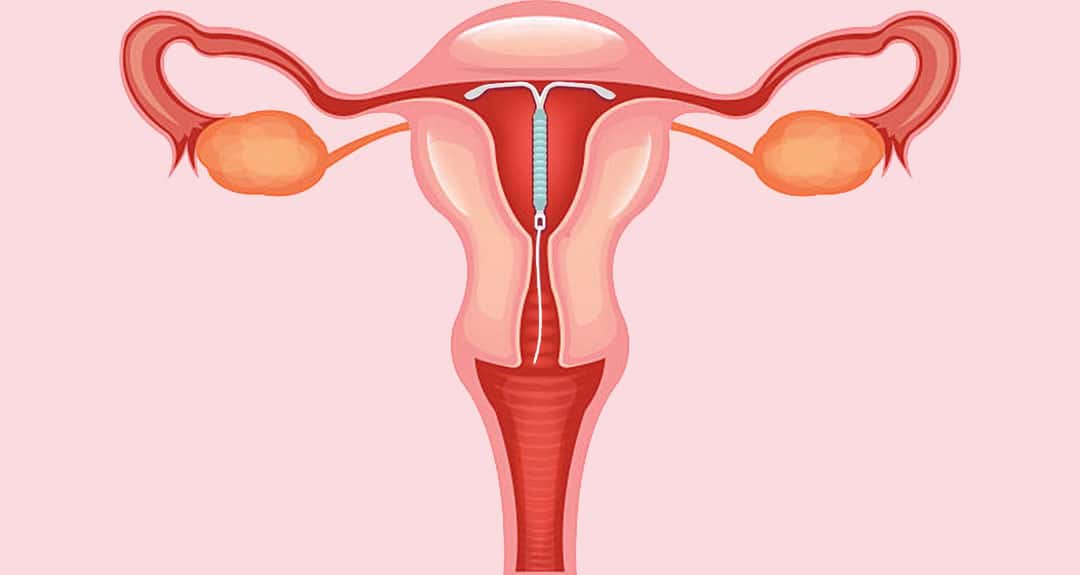 Everything you need to know about intrauterine contraceptive devices (IUD)