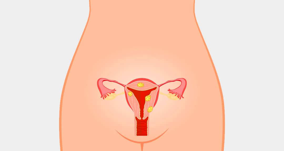 All about Uterine fibroids